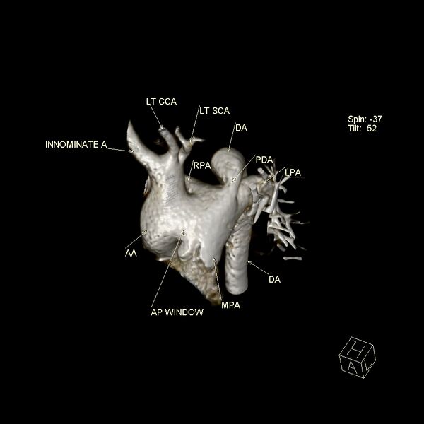 File:Aortopulmonary window, interrupted aortic arch and large PDA giving the descending aorta (Radiopaedia 35573-37077 3D 4).jpg