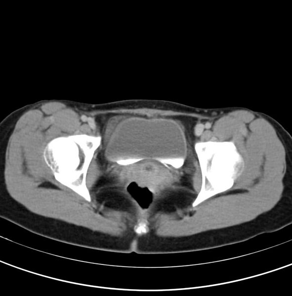 File:Appendicitis and incidental bicornuate uterus (Radiopaedia 22833-22853 Axial C+ delayed 38).jpg