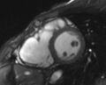 Arrhythmogenic right ventricular cardiomyopathy (Radiopaedia 69564-79464 short axis cine 142).jpg