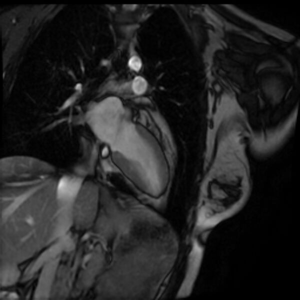 File:Arrhythmogenic right ventricular cardiomyopathy (Radiopaedia 87505-103850 2ch (LV) Cine SSFP 25).jpg