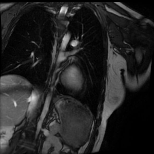 File:Arrhythmogenic right ventricular cardiomyopathy (Radiopaedia 87505-103850 2ch (LV) Cine SSFP 74).jpg
