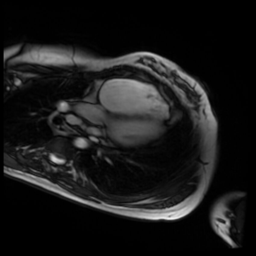 Arrhythmogenic right ventricular cardiomyopathy (Radiopaedia 87505-103850 4ch Cine SSFP 3).jpg