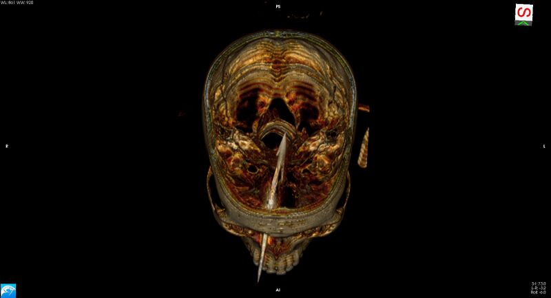 File:Arrow injury to the brain (Radiopaedia 72101-82607 3D bone 18).jpg