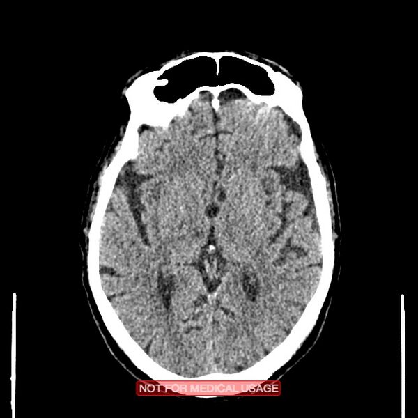 File:Artery of Percheron infarction (Radiopaedia 28679-28967 Axial non-contrast 60).jpg
