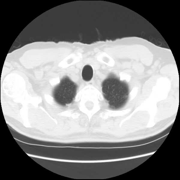 File:Asbestos-related pleural plaques (Radiopaedia 39069-41255 Axial lung window 6).jpg