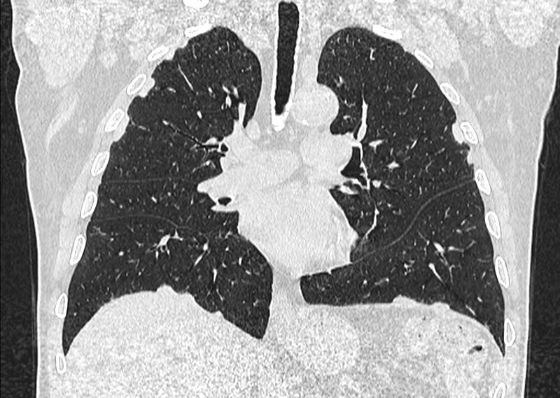 File:Asbestos pleural placques (Radiopaedia 57905-64872 Coronal lung window 143).jpg