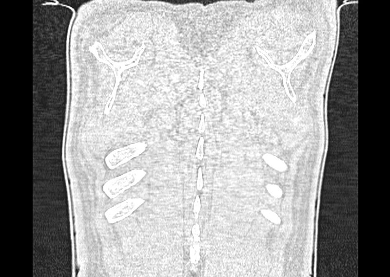 File:Asbestos pleural placques (Radiopaedia 57905-64872 Coronal lung window 288).jpg