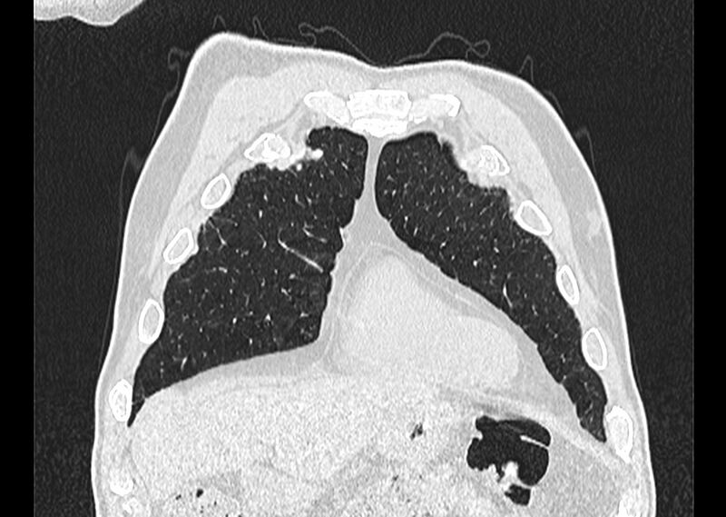 File:Asbestos pleural placques (Radiopaedia 57905-64872 Coronal lung window 41).jpg