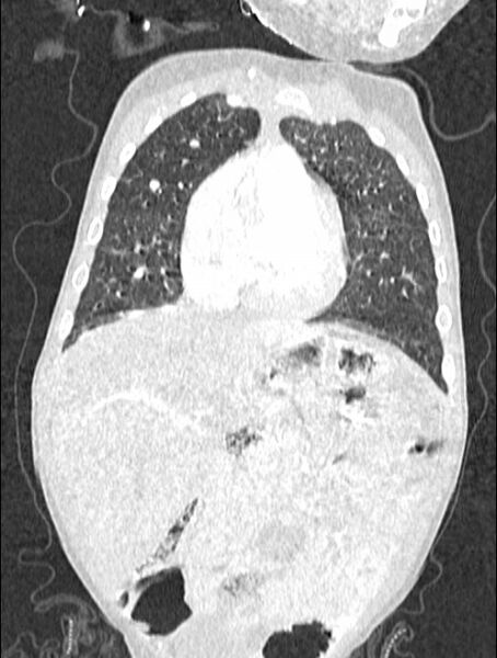 File:Asplenia syndrome (Radiopaedia 73083-83792 Coronal lung window 40).jpg
