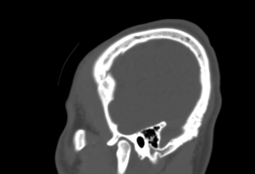 Asymptomatic occipital spur (Radiopaedia 87753-104201 Sagittal bone window 278).jpg