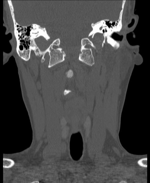 File:Atlanto-occipital assimilation with basilar invagination (Radiopaedia 70122-80188 Coronal bone window 61).jpg