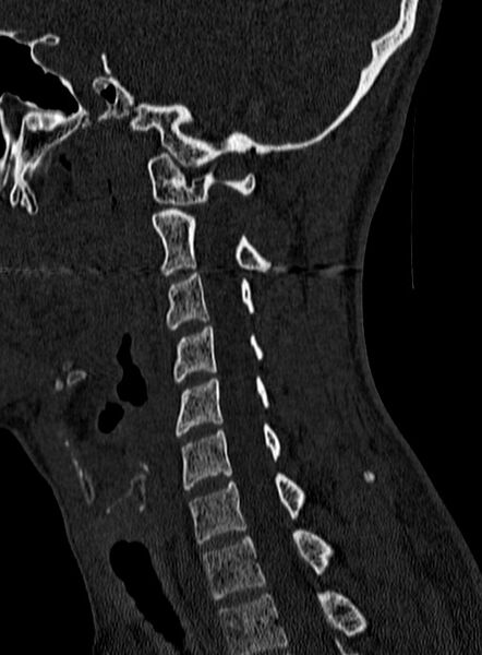 File:Atlantoaxial subluxation (Radiopaedia 44681-48450 Sagittal bone window 99).jpg