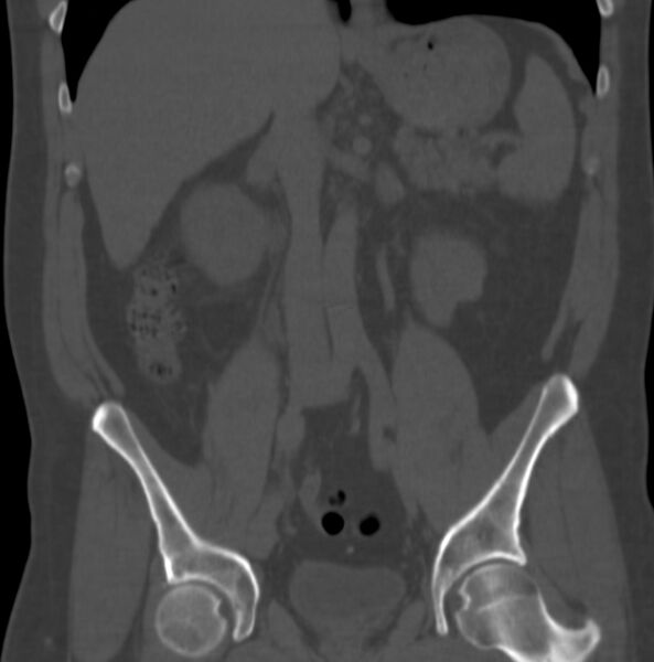 File:Atrophic kidney due to severe chronic obstructive hydronephrosis (Radiopaedia 40828-43474 Coronal bone window 2).jpg
