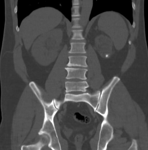 File:Atrophic kidney due to severe chronic obstructive hydronephrosis (Radiopaedia 40828-43474 Coronal bone window 7).jpg