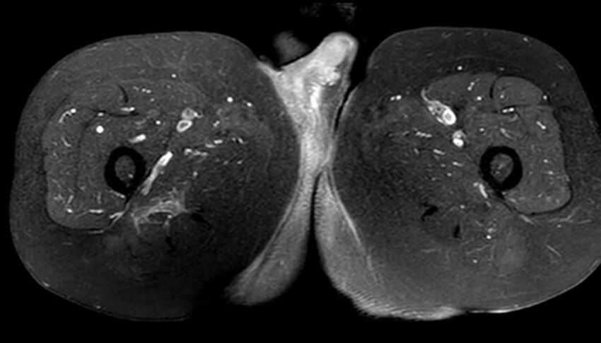 Atypical lipomatous tumor - thigh (Radiopaedia 68975-78734 Axial T1 C+ fat sat 68).jpg