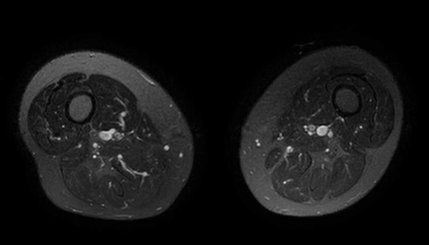 Atypical lipomatous tumor - thigh (Radiopaedia 68975-78734 Axial T2 fat sat 38).jpg