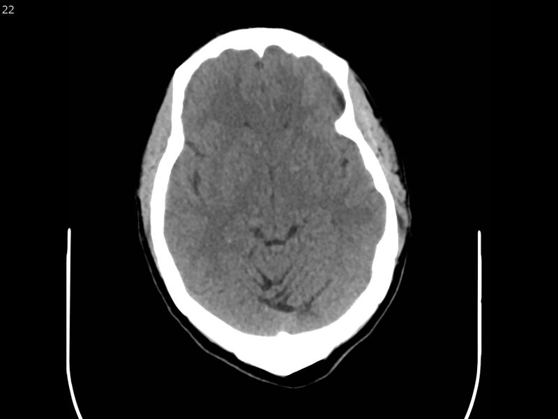 File:Atypical meningioma - intraosseous (Radiopaedia 64915-73867 A 22).jpg