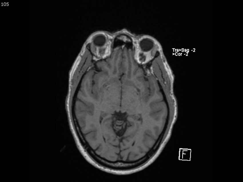 Atypical meningioma - intraosseous (Radiopaedia 64915-74572 Axial T1 105).jpg
