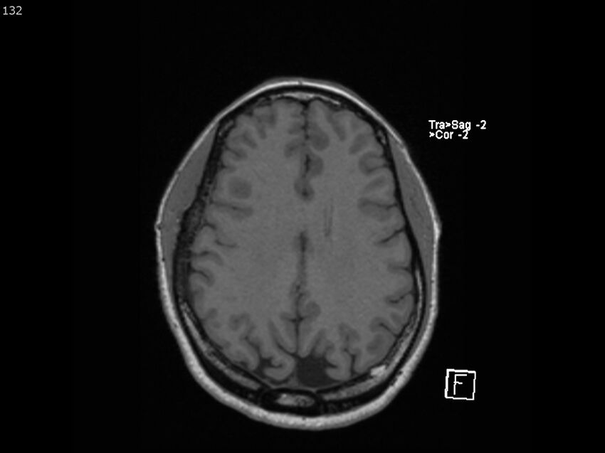 Atypical meningioma - intraosseous (Radiopaedia 64915-74572 Axial T1 132).jpg