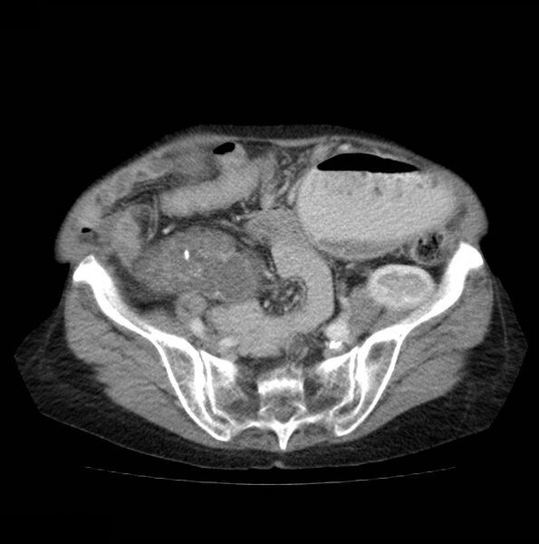 File:Autosomal dominant polycystic kidney disease (Radiopaedia 16777-16490 A 44).jpg