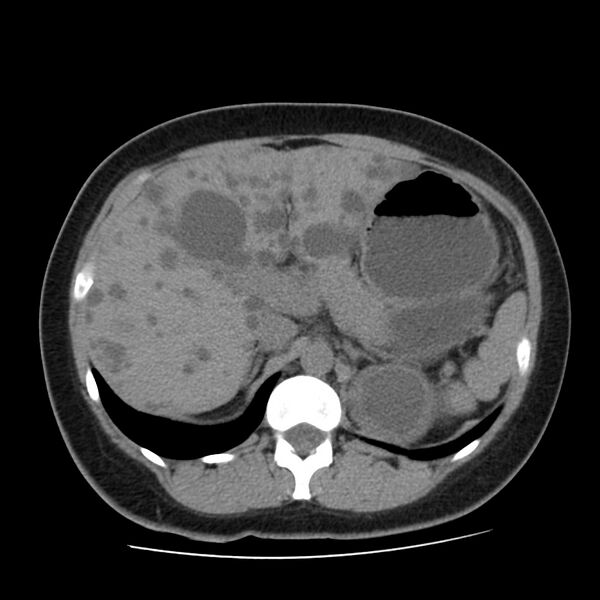 File:Autosomal dominant polycystic kidney disease (Radiopaedia 23061-23093 Axial non-contrast 17).jpg