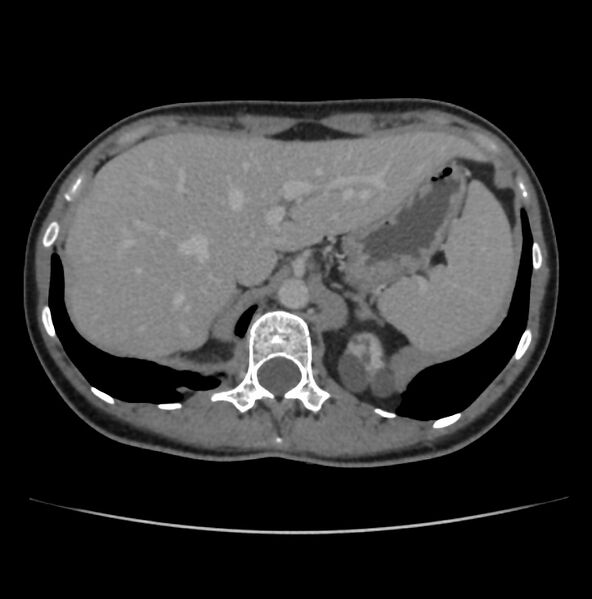 File:Autosomal dominant polycystic kidney disease - early onset (Radiopaedia 40734-43387 A 7).jpg