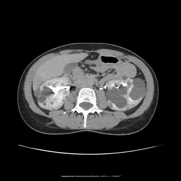 File:Autosomal dominant polycystic kidney disease - early onset (Radiopaedia 40734-43387 D 9).jpg