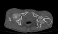 Avascular necrosis of the left hip (Radiopaedia 75068-86125 Axial bone window 66).jpg