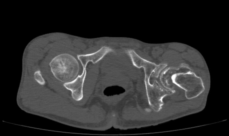 File:Avascular necrosis of the left hip (Radiopaedia 75068-86125 Axial bone window 66).jpg