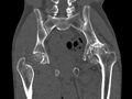 Avascular necrosis of the left hip (Radiopaedia 75068-86125 Coronal bone window 47).jpg