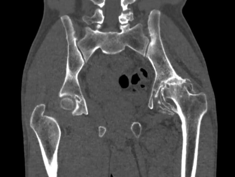 File:Avascular necrosis of the left hip (Radiopaedia 75068-86125 Coronal bone window 47).jpg