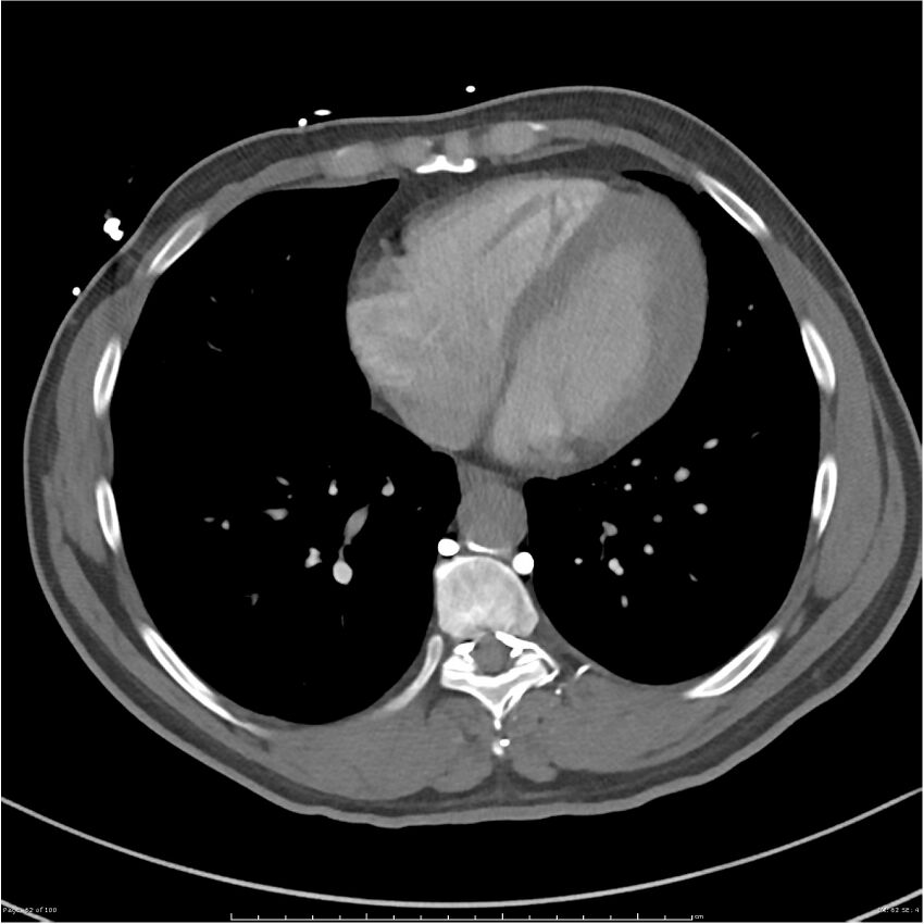 Azygos venous system anatomy (CT pulmonary angiography) (Radiopaedia 25928-26077 Axial C+ CTPA 62).jpg