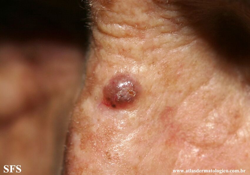 Basal Cell Carcinoma (Dermatology Atlas 339).jpg