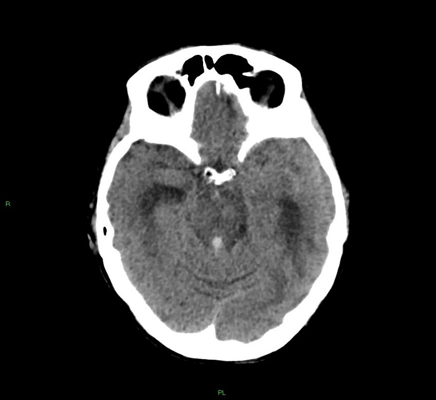 Basal ganglia hemorrhage (Radiopaedia 58766-65988 Axial non-contrast 38).jpg