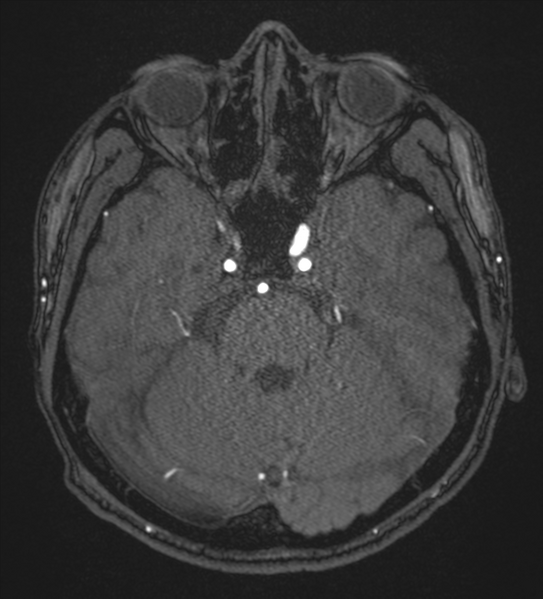 File:Basal ganglia subacute infarct (Radiopaedia 80201-93521 Axial MRA 31).png