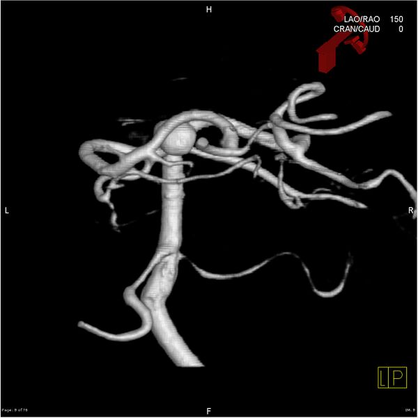File:Basilar tip aneurysm double balloon remodeling (Radiopaedia 18100-17883 3D rotation 8).jpg