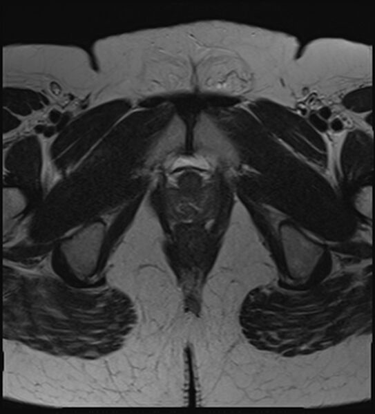 File:Bicornuate, unicollis uterus (Radiopaedia 79468-92593 Axial T2 24).jpg
