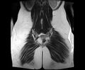 Bicornuate bicollis uterus (Radiopaedia 61626-69616 Coronal T2 32).jpg