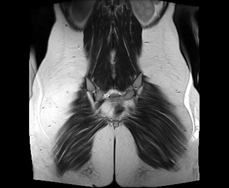 File:Bicornuate bicollis uterus (Radiopaedia 61626-69616 Coronal T2 32).jpg
