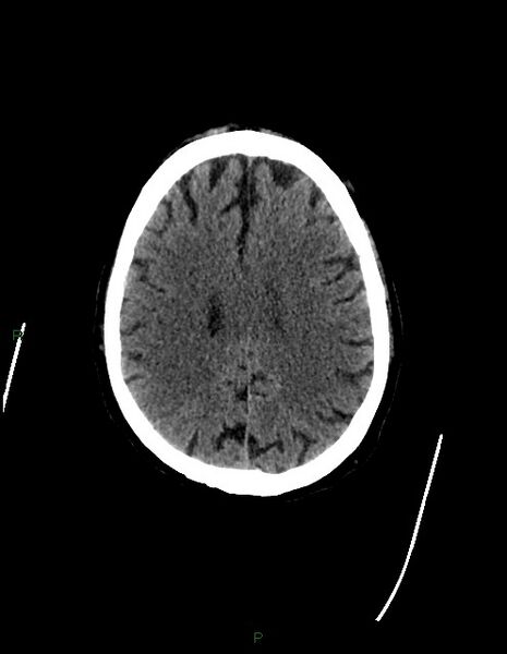 File:Bilateral acute middle cerebral artery territory infarcts (Radiopaedia 77319-89401 Axial non-contrast 60).jpg