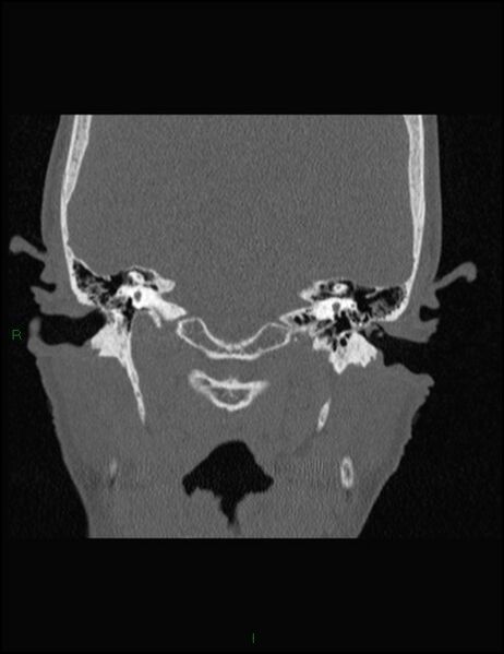 File:Bilateral frontal mucoceles (Radiopaedia 82352-96454 Coronal 311).jpg
