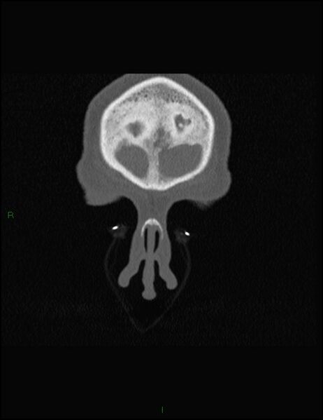File:Bilateral frontal mucoceles (Radiopaedia 82352-96454 Coronal 38).jpg