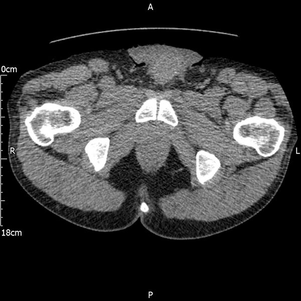 File:Bilateral medullary nephrocalcinosis with ureteric calculi (Radiopaedia 71269-81569 Axial non-contrast 139).jpg