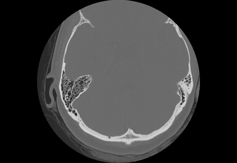 File:Bilateral otospongiosis (Radiopaedia 35447-36940 B 50).jpg
