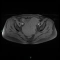 Bilateral ovarian fibroma (Radiopaedia 44568-48293 Axial T1 fat sat 14).jpg