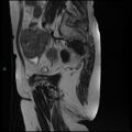 Bilateral ovarian fibroma (Radiopaedia 44568-48293 Sagittal T2 9).jpg