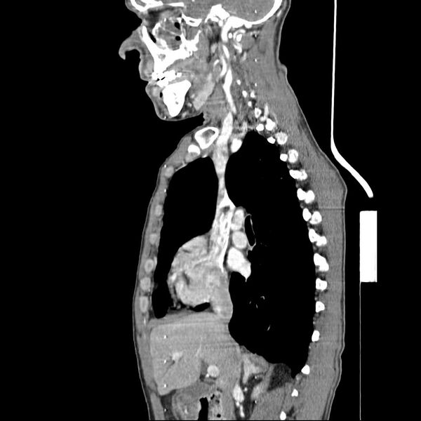 File:Bilateral parotid gland lymphoma (Radiopaedia 21038-20969 C 12).jpg