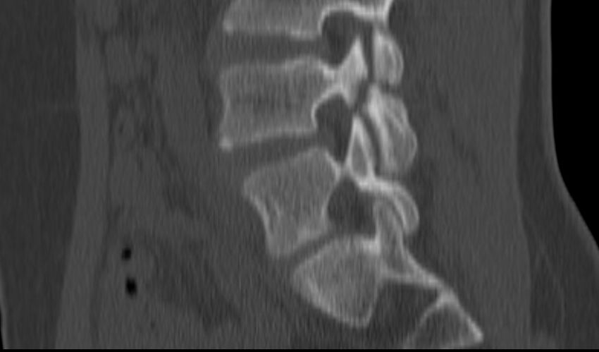 Bilateral pars defect (Radiopaedia 26691-26846 Sagittal bone window 39).jpg