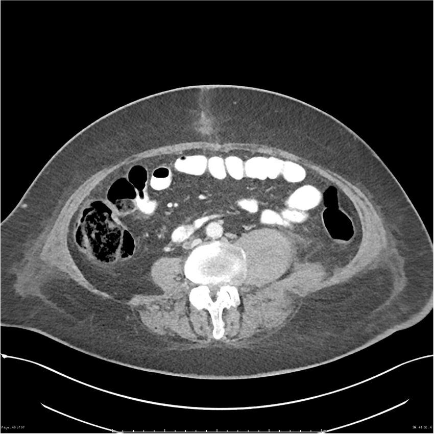 Bilateral psoas hematomas (Radiopaedia 24057-24279 A 49).jpg