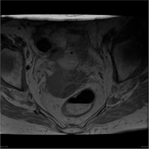 File:Bilateral psoas hematomas (Radiopaedia 24057-24280 T1 1).jpg